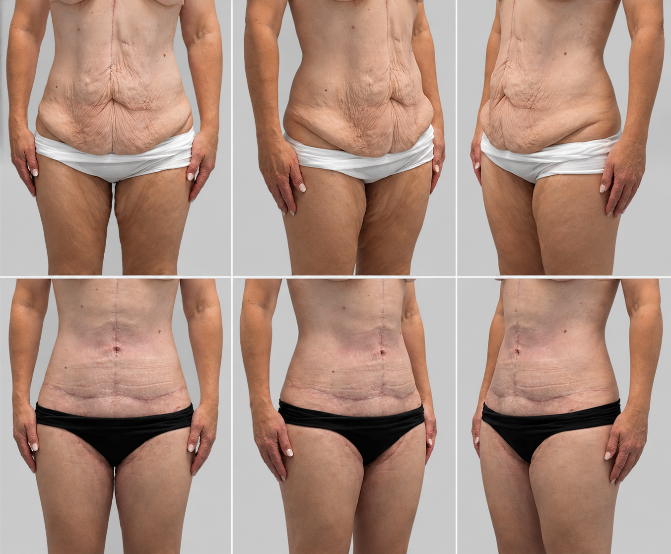 Before-and-after abdominoplasty photographs showing front and oblique views.