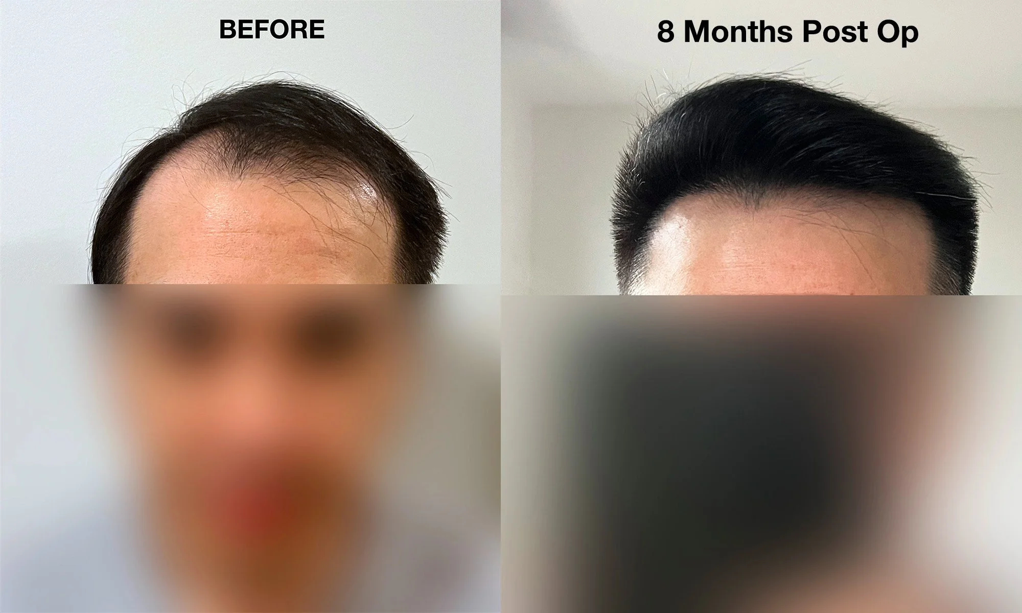 Before and 8 months after my 4,300 graft hair transplant in Bangkok, showing the change in my hairline and hair density.