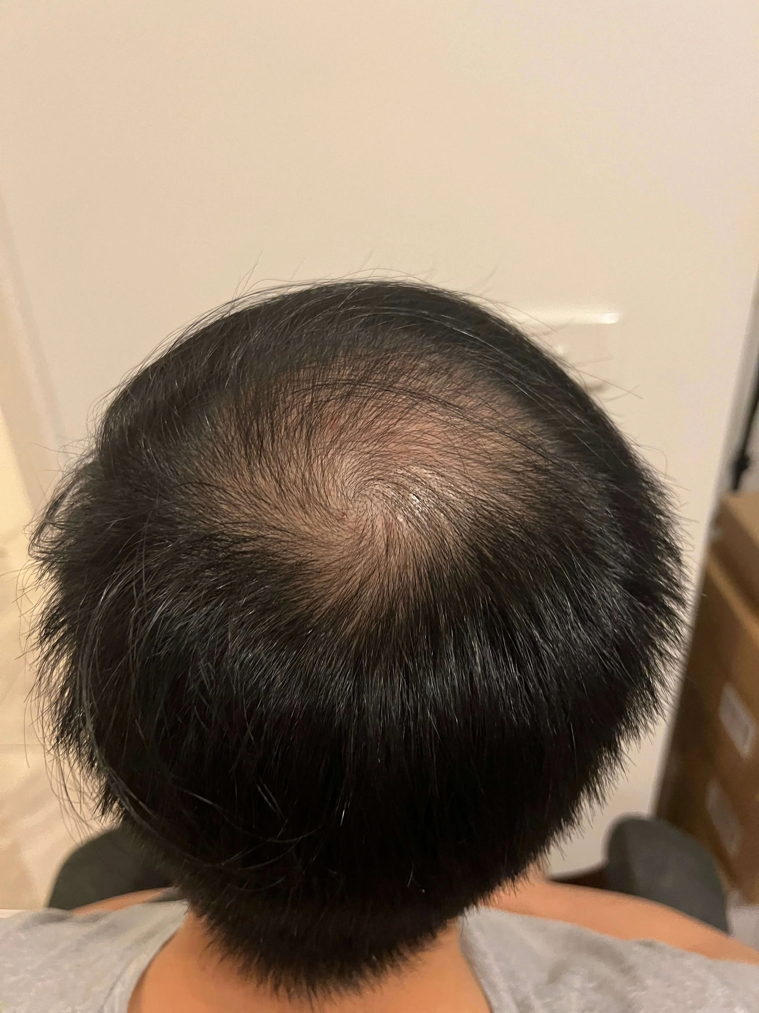 This is Zack's pre-surgery hair loss back view of the crown