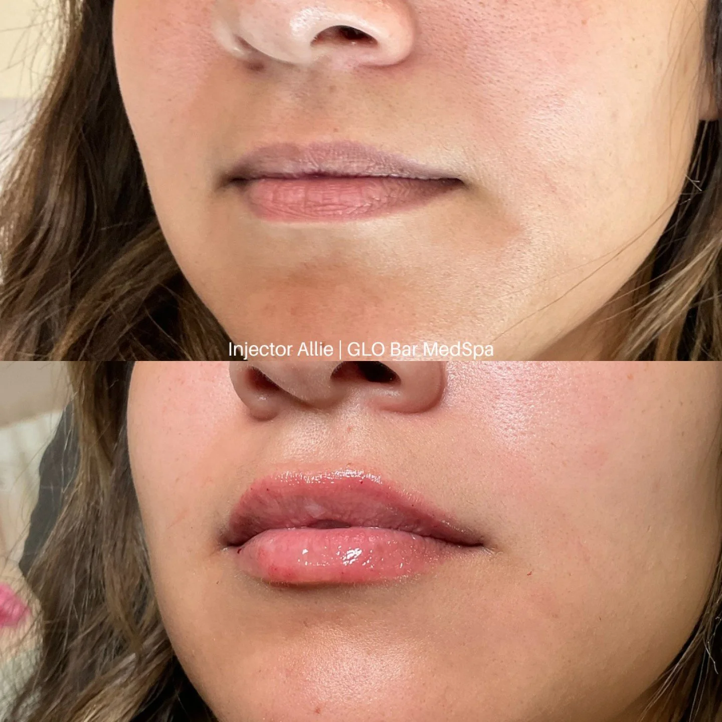 Before &amp; After of our signature Lip GLO Up 💉 

Prioritizing balance, hydration &amp; symmetry for a plump yet natural-looking result 👄 

#ocinjector #ocmedspa