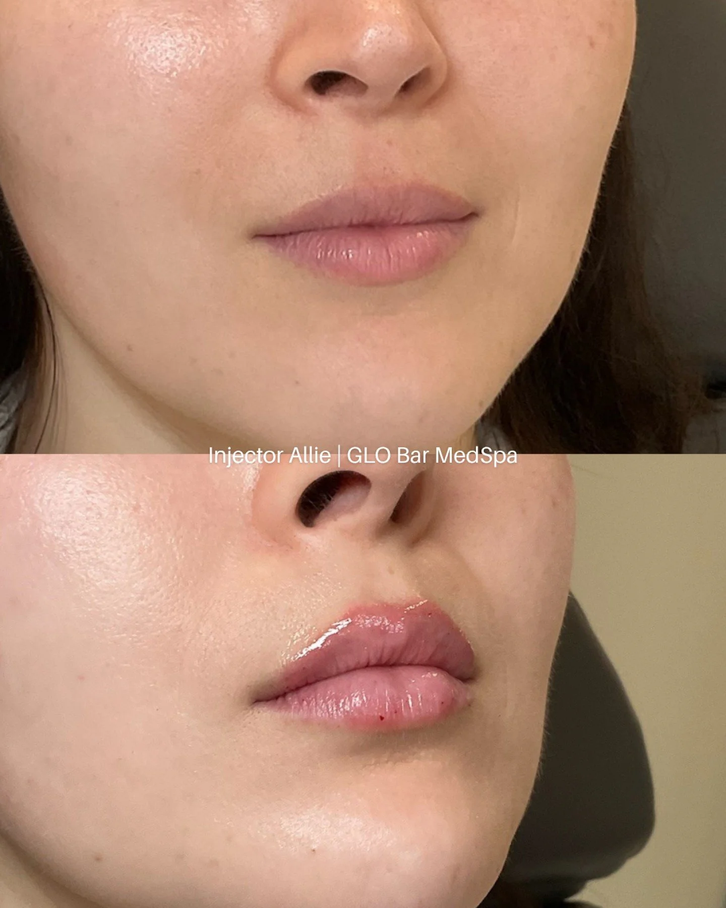 The SCIENCE behind lip filler 👄

Every lip is different, so every approach is too. Hydrated, natural, and built around your anatomy.

Curious about our Lip GLO Up? Drop your questions below 🩶

#LipFiller #CostaMesaMedSpa #GLOBar #LipGLOUp