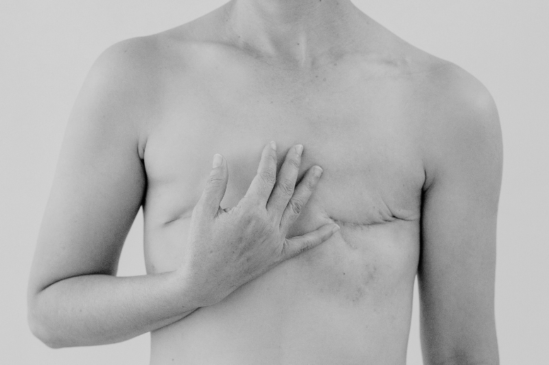 Reconstruction mammaire : faire un choix éclairé