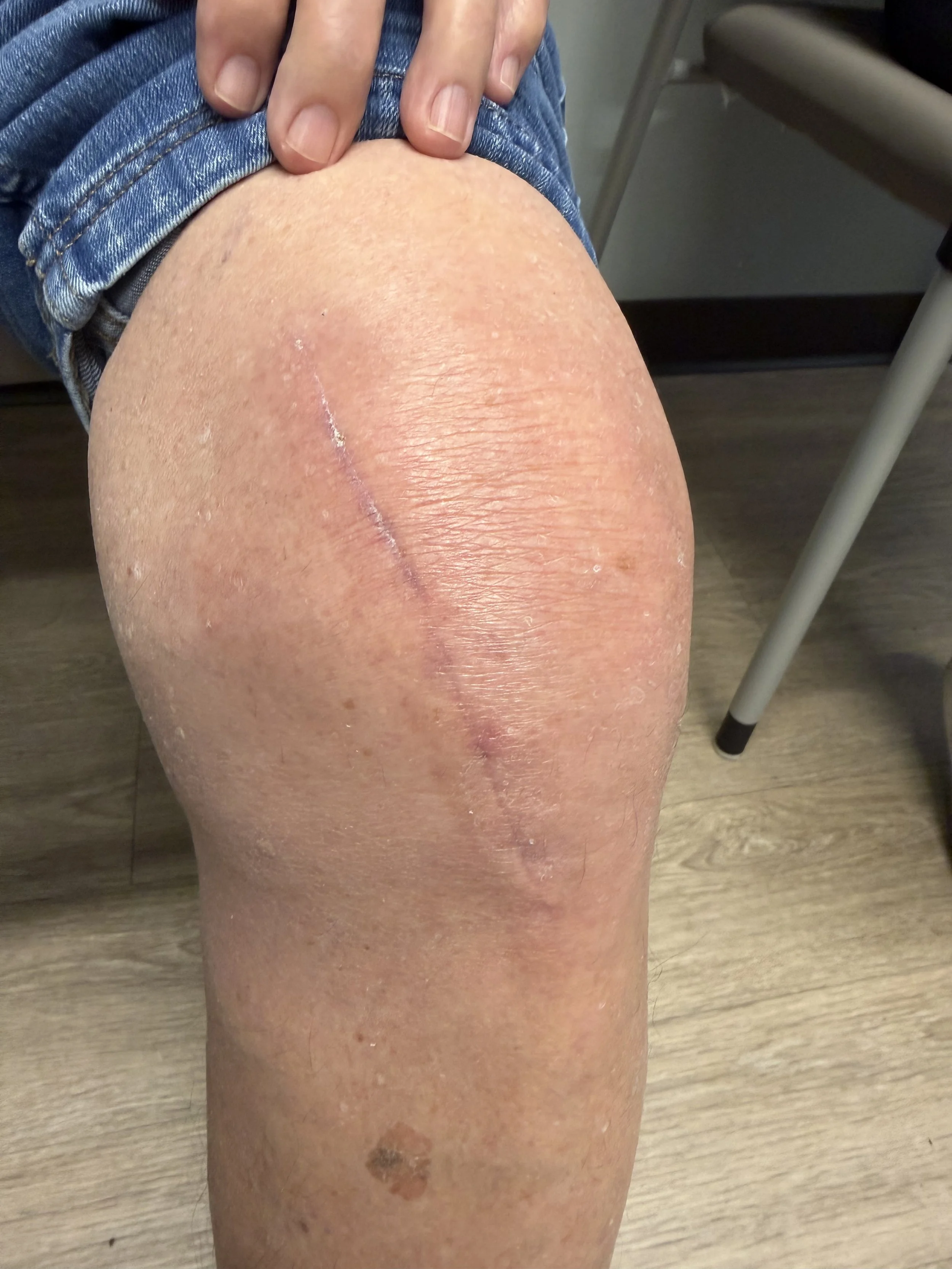 jiffy subvastus total knee Expert Orthopaedic Care, Demorest, GA Kris Wheeler, MD