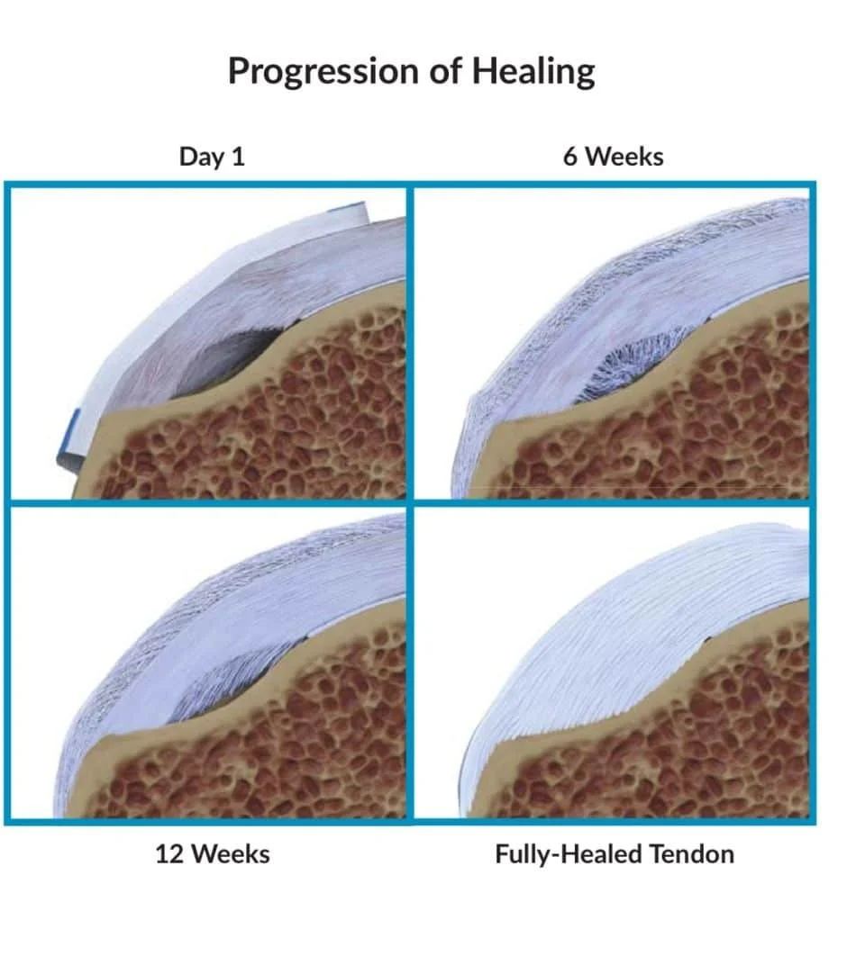 Progression of healing in a tendon over different weeks. The top left shows day 1, the top right shows 6 weeks, the bottom left shows 12 weeks, and the bottom right shows a fully-healed tendon, each with cross-sections of tendon tissue illustrating healing stages.