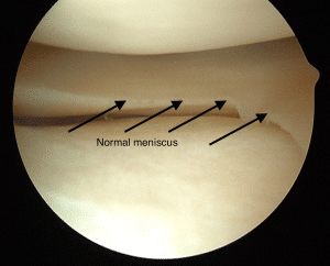meniscus tear Expert Orthopaedic Care, Demorest, GA Kris Wheeler, MD