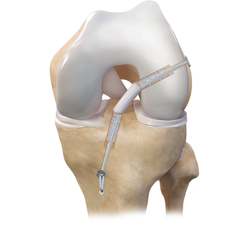 Medical illustration of a knee ACL surgery