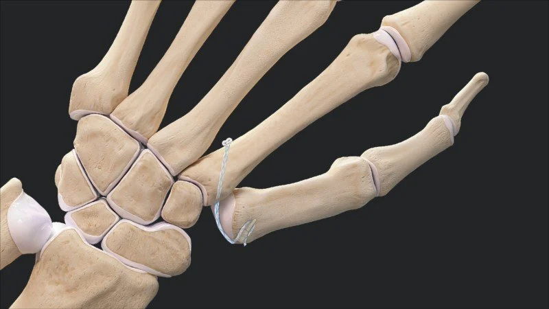 cmc joint arthroplasty