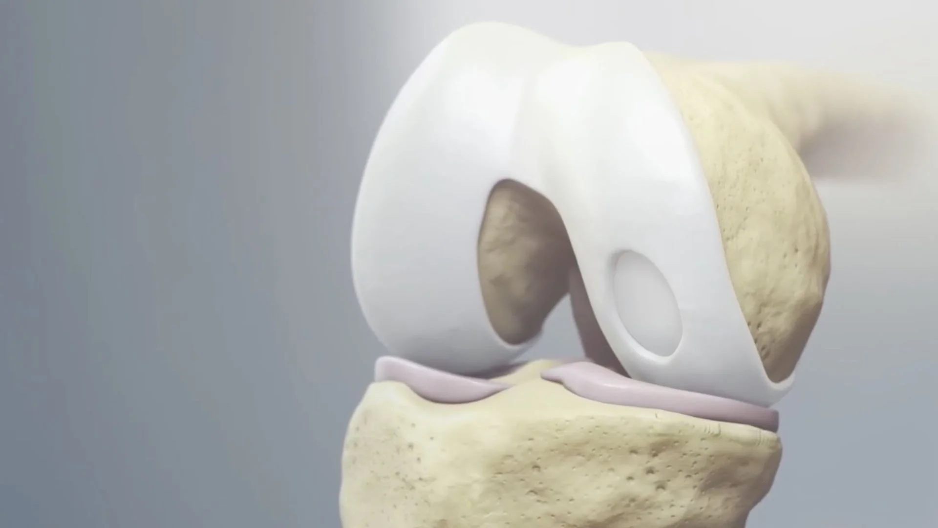 Cartilage reconstruction knee surgery  Dr. Kris Wheeler Demorest GA