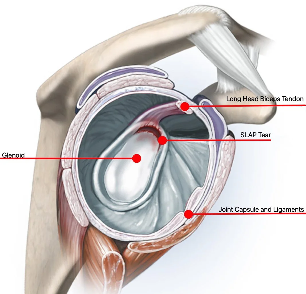 Anatomical diagram of a shoulder joint showing the glenoid cavity, joint capsule and ligaments, long head biceps tendon, and a SLAP tear.