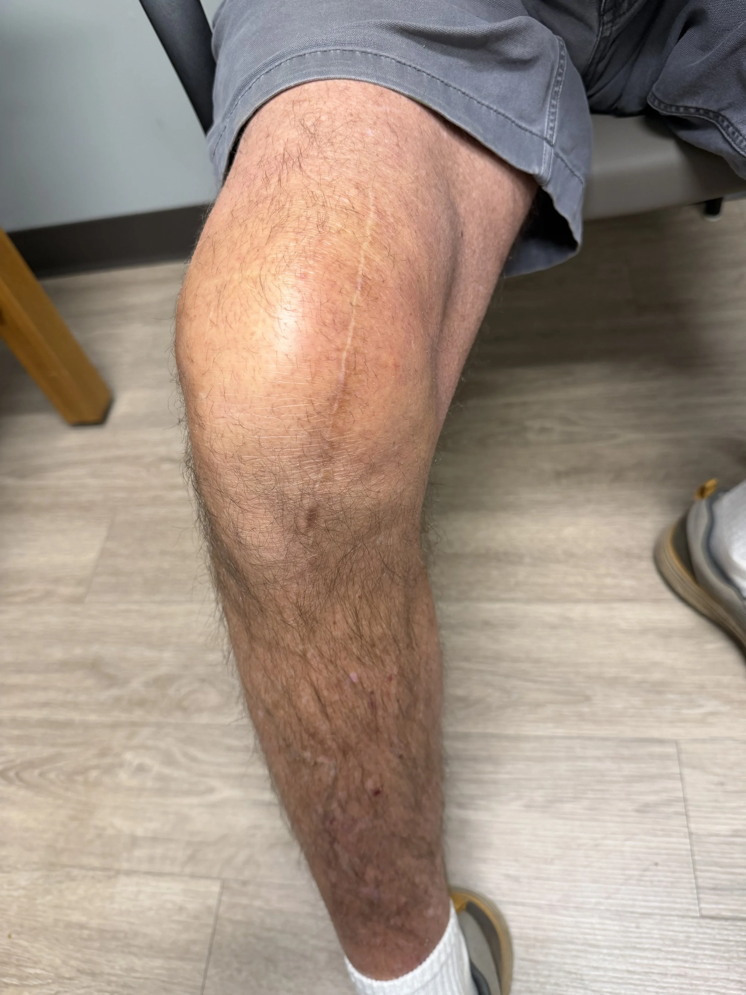 jiffy subvastus knee replacement dr wheeler Demorest ga
