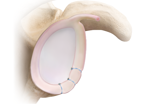 shoulder surgery. demorest, GA. Kris Wheeler, MD