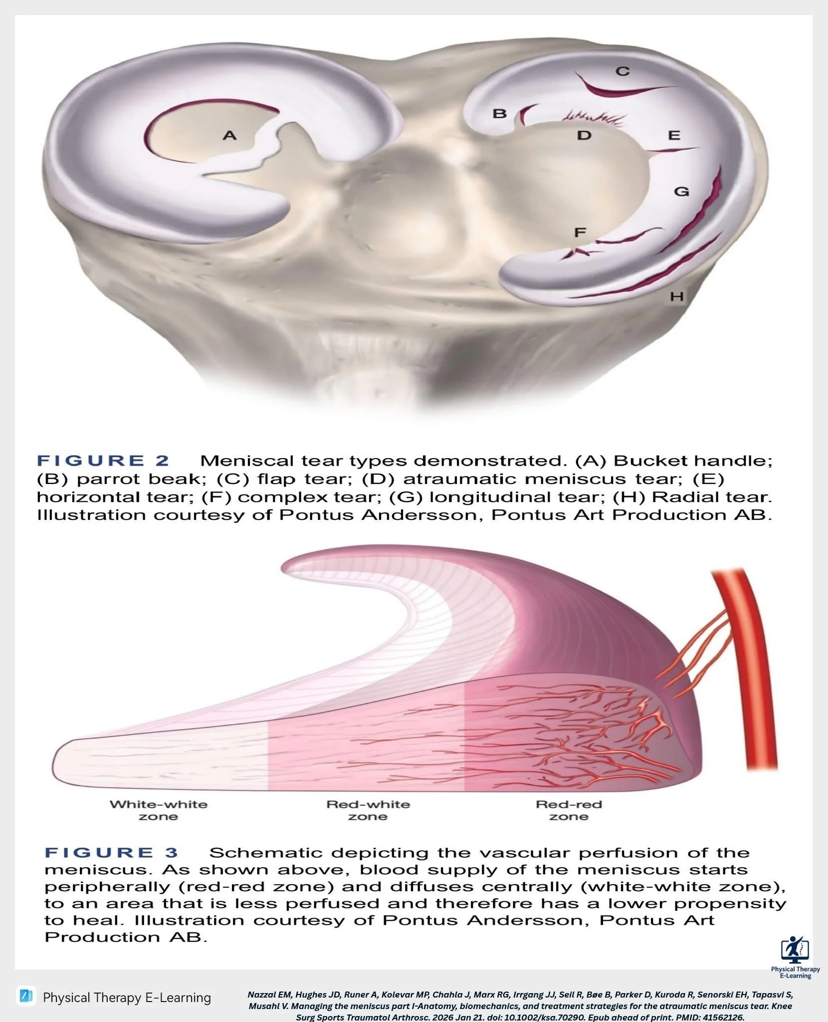meniscus tear Expert Orthopaedic Care, Demorest, GA Kris Wheeler, MD