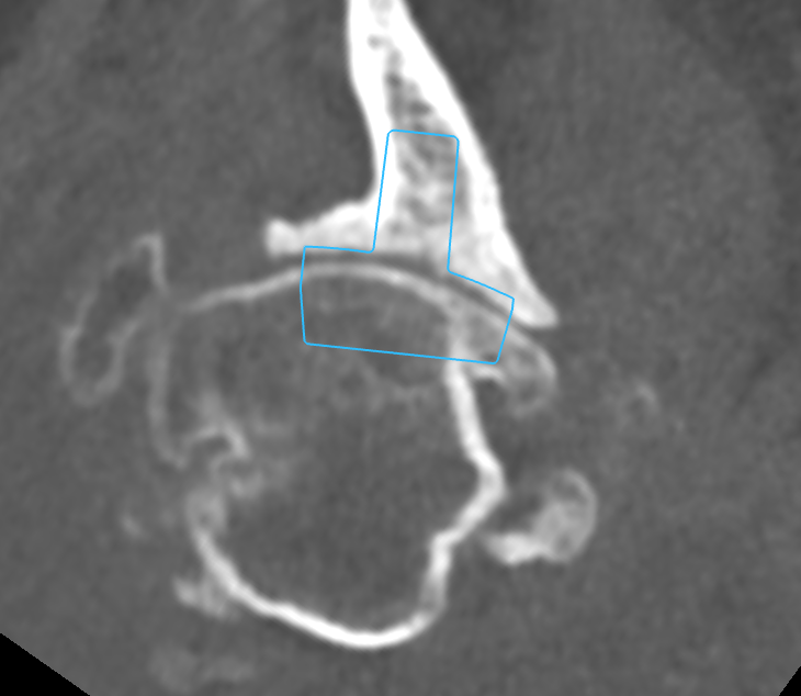 dr wheeler shoulder replacement