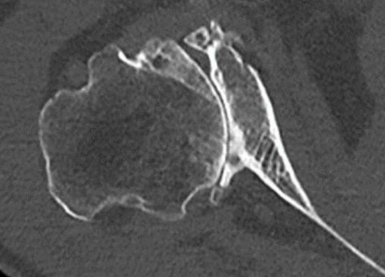 dr wheeler shoulder replacement
