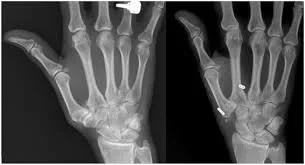 CMC arthritis