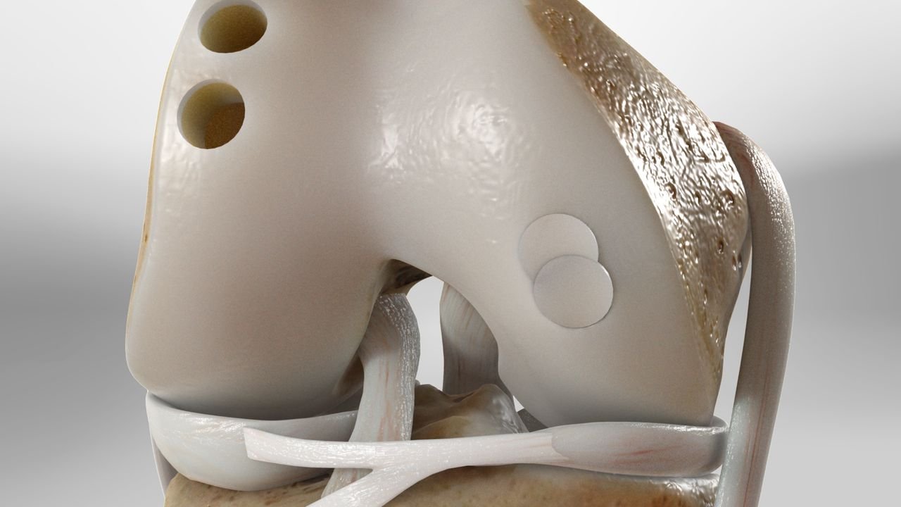 Dr Kris Wheeler, Demorest GA, Cartilage repair OATS procedure Orthopedics