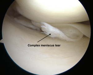 meniscus tear Expert Orthopaedic Care, Demorest, GA Kris Wheeler, MD
