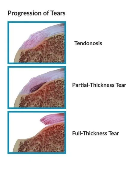Illustration showing the progression of tears in tissue: tendonosis, partial-thickness tear, and full-thickness tear.