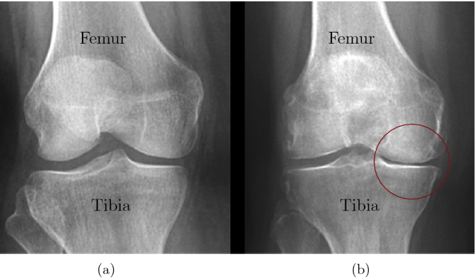 knee replacement Demorest dr wheeler jiffy knee