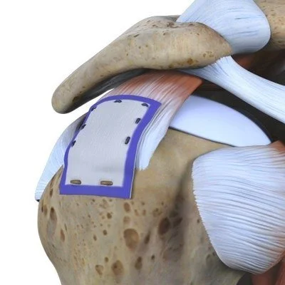 Close-up illustration of an inflamed human shoulder joint with muscles, tendons, and a medical patch covering the joint area.