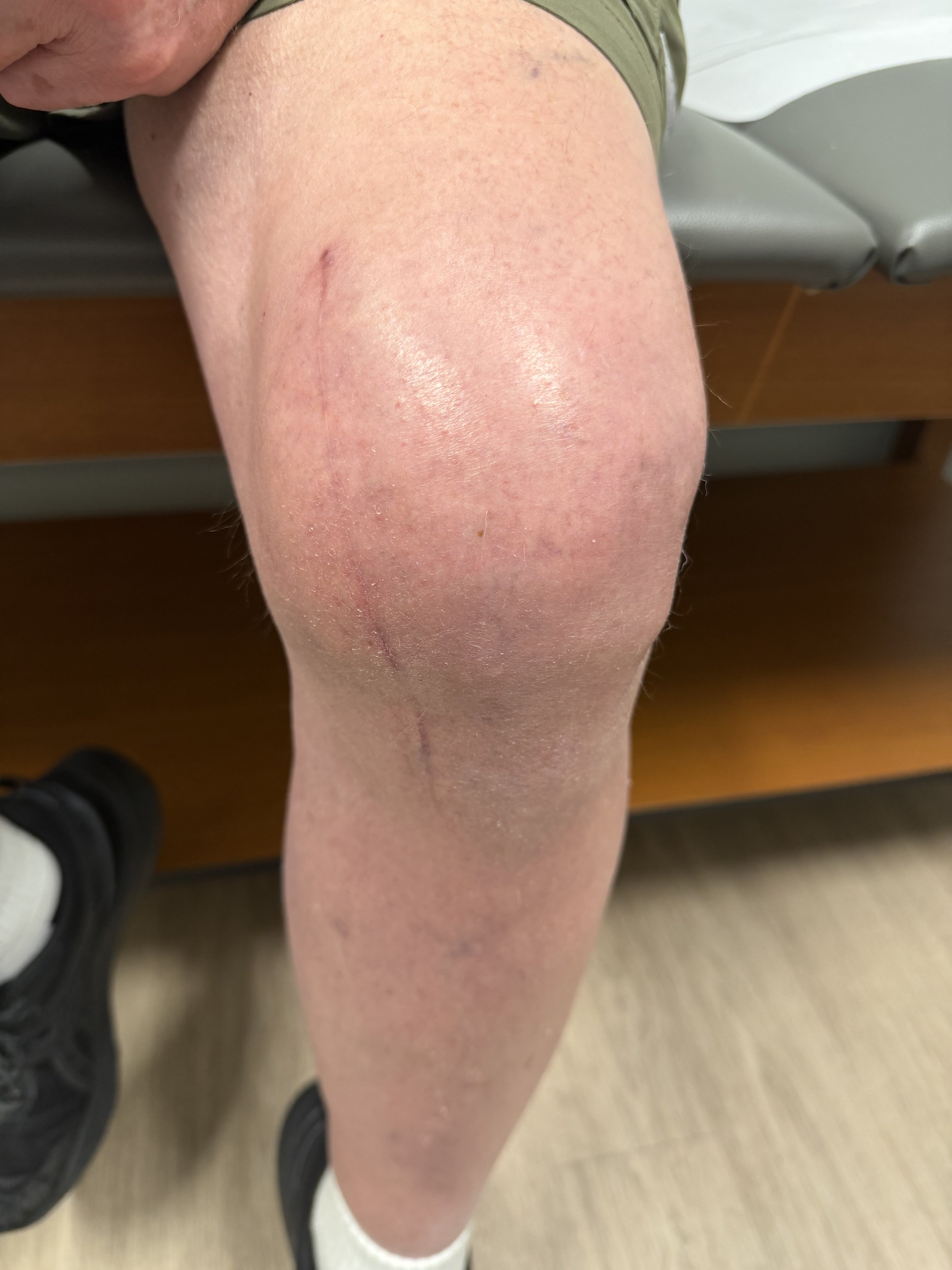 jiffy subvastus knee replacement dr wheeler Demorest GA
