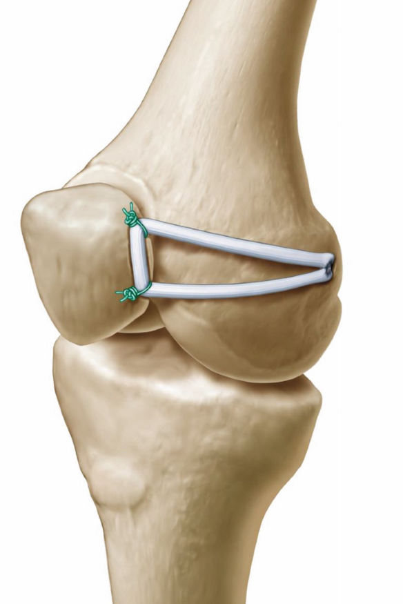 MPFL reconstruction. Demorest, GA. Kris Wheeler, MD