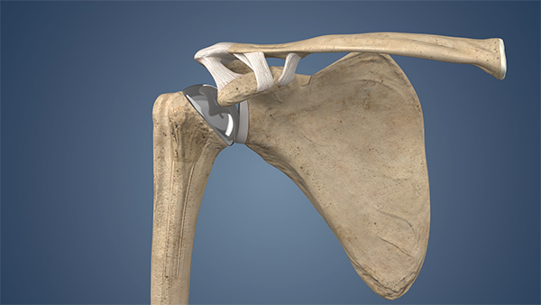 shoulder replacement north georgia