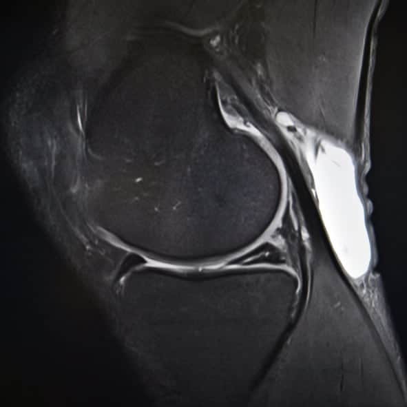 meniscus tear Expert Orthopaedic Care, Demorest, GA Kris Wheeler, MD