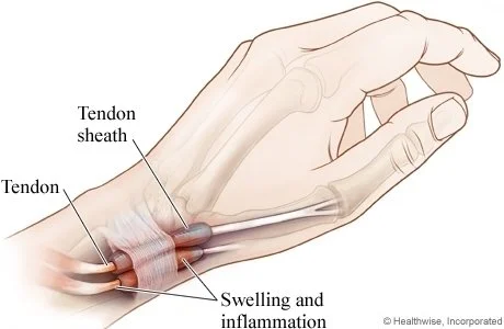 Dequervains tenosynovitis