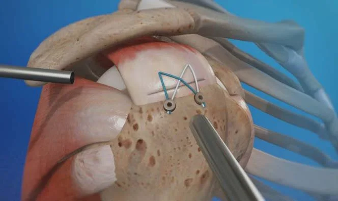 Rotator cuff repair