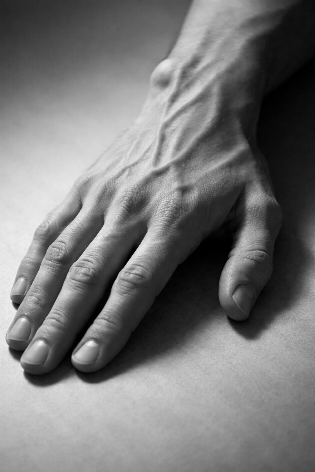 hand injuries, carpal tunnel, trigger finger, ganglion cyst Expert Orthopaedic Care, Demorest, GA Kris Wheeler, MD