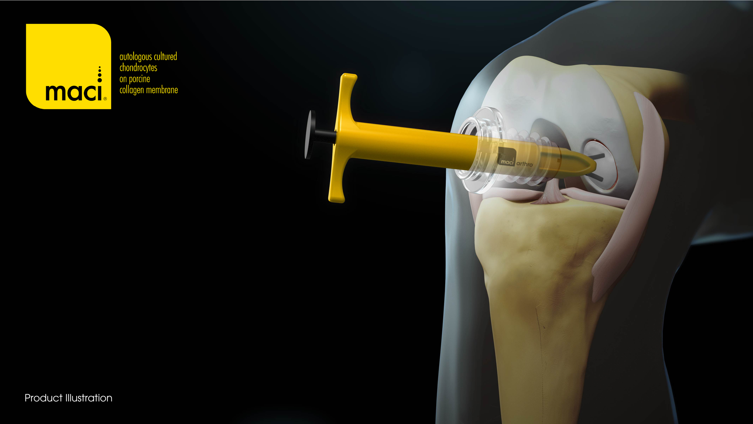 Dr. Kris Wheeler MACI Demorest GA cartilage recontruction