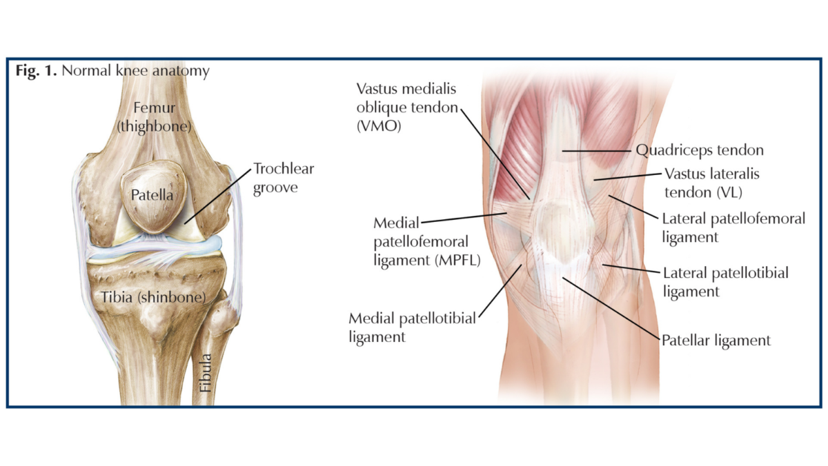Diagram showing normal knee anatomy with labels for bones and ligaments, including femur, tibia, fibula, and various tendons and ligaments such as quadriceps tendon, lateral and medial patellofemoral ligaments, patellar ligament, and others.