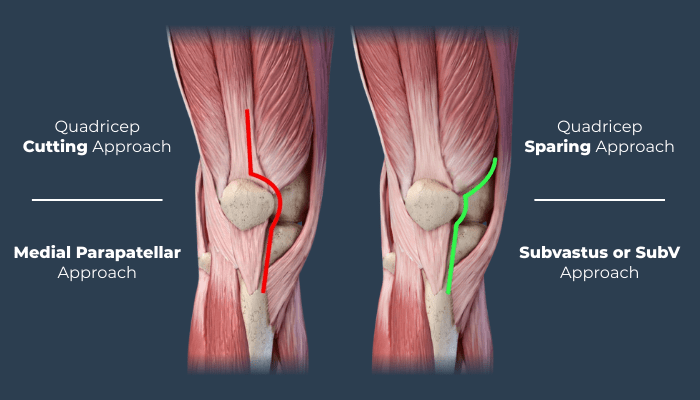 jiffy knee subvastus knee dr wheeler Demorest