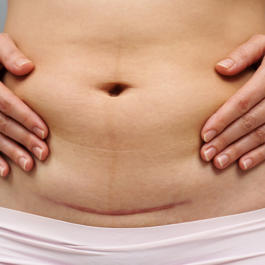 C-section recovery chiropractic treatment in Aurora, Ontario