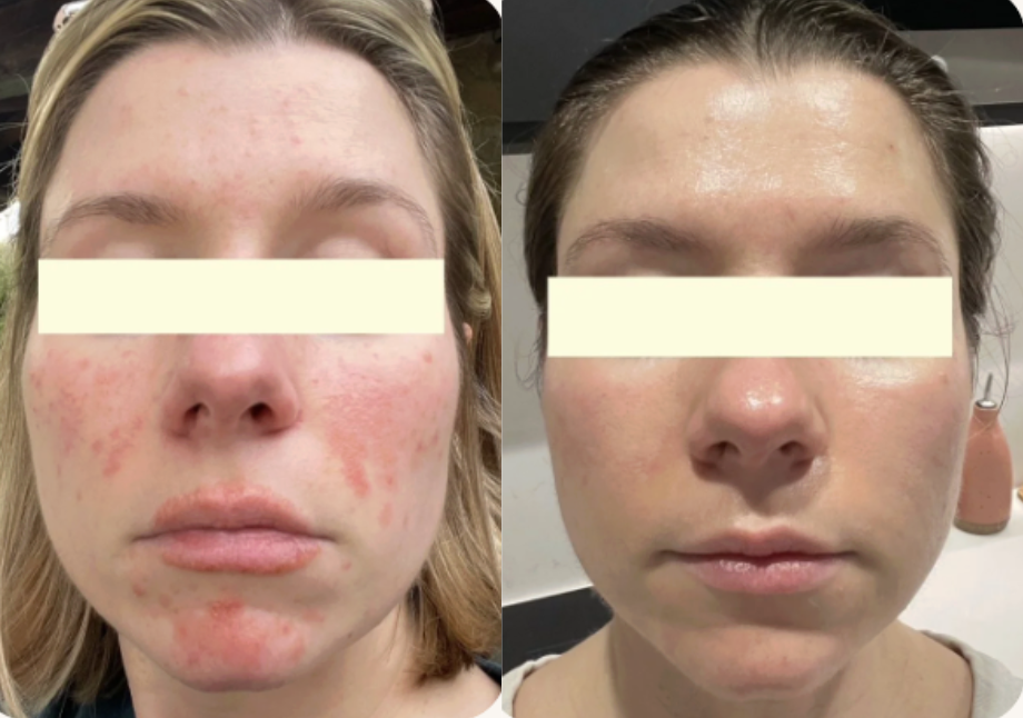 Root cause acne specialist and naturopathic doctor offering virtual 1:1 sessions and functional lab testing to uncover hormonal, gut, and lifestyle imbalances driving acne. Clear your skin from the inside out with personalized, holistic care.