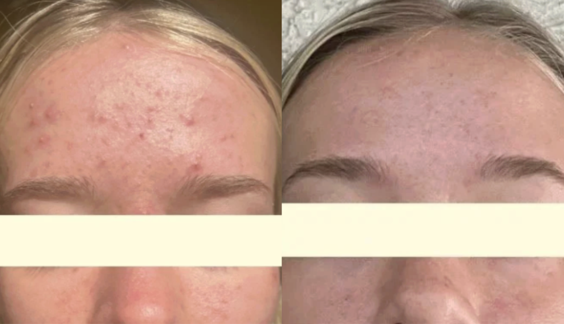 Root cause acne specialist and naturopathic doctor offering virtual 1:1 sessions and functional lab testing to uncover hormonal, gut, and lifestyle imbalances driving acne. Clear your skin from the inside out with personalized, holistic care.
