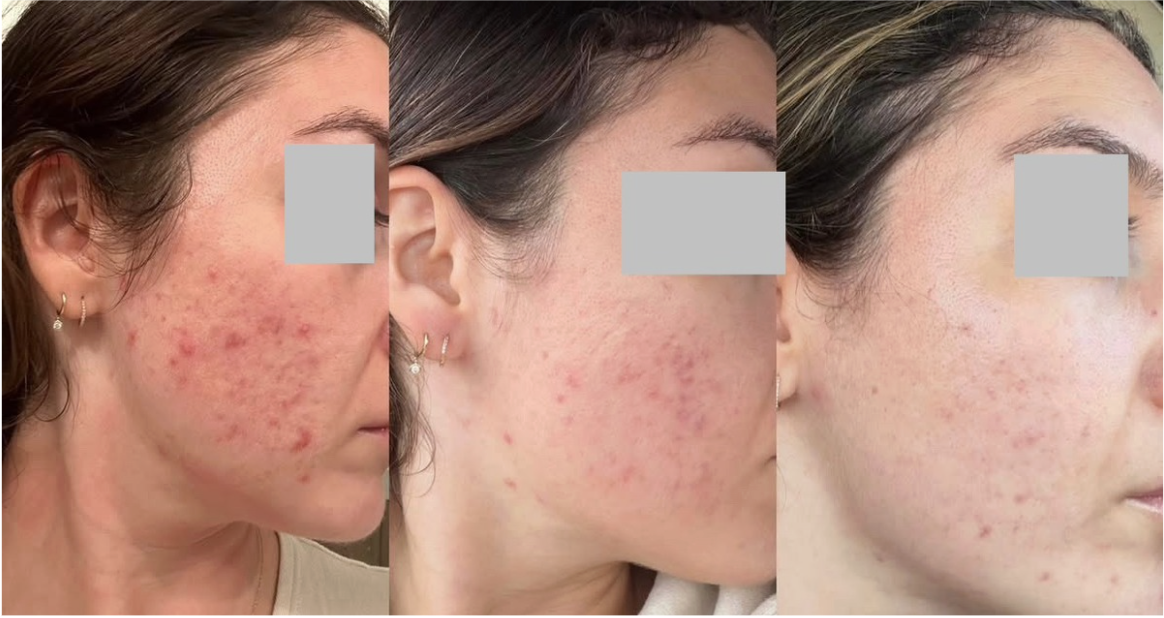 Root cause acne specialist and naturopathic doctor offering virtual 1:1 sessions and functional lab testing to uncover hormonal, gut, and lifestyle imbalances driving acne. Clear your skin from the inside out with personalized, holistic care.