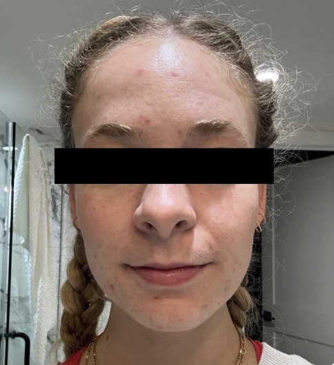 Close-up of a young woman's face with acne and redness, smiling with her eyes covered by a black bar, in what appears to be a medical or clinic setting.