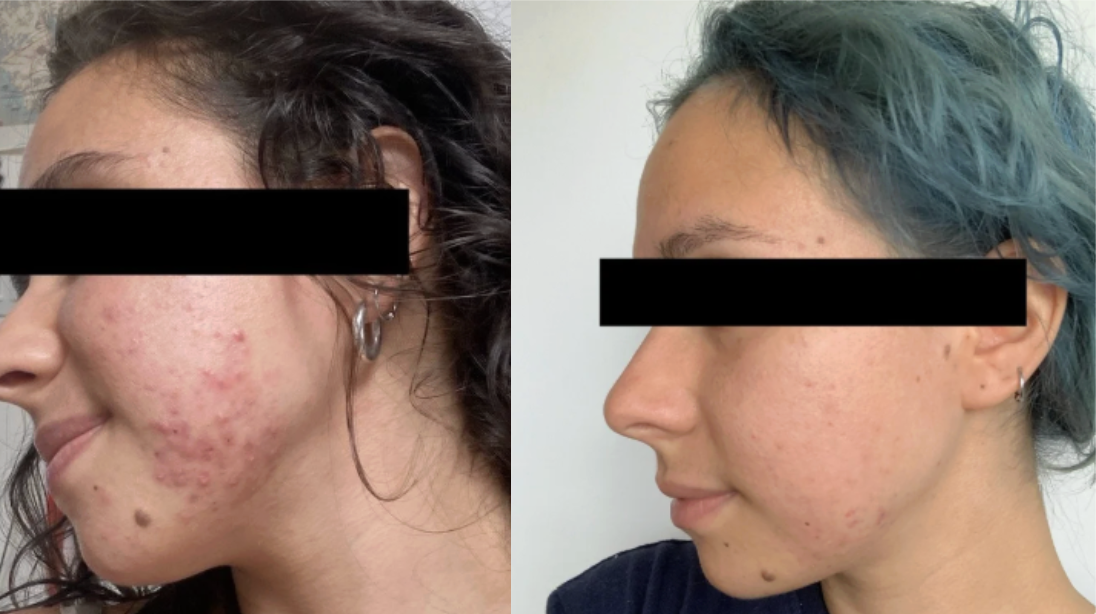 Root cause acne specialist and naturopathic doctor offering virtual 1:1 sessions and functional lab testing to uncover hormonal, gut, and lifestyle imbalances driving acne. Clear your skin from the inside out with personalized, holistic care.