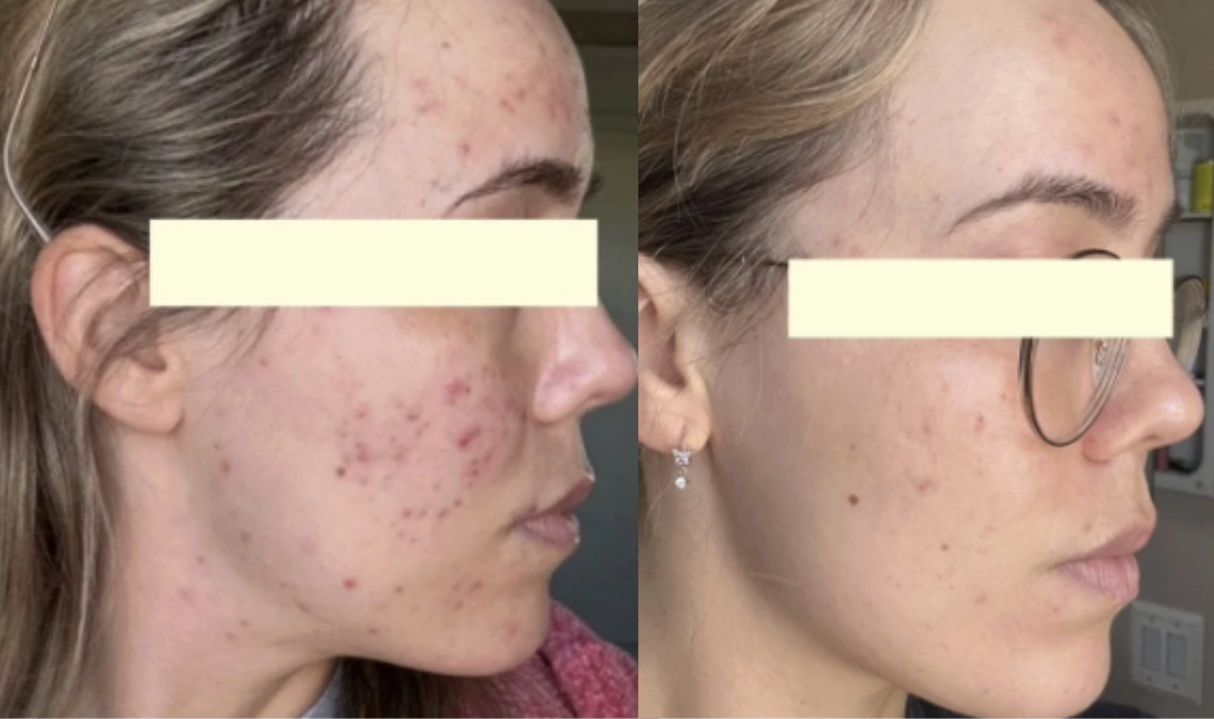 Root cause acne specialist and naturopathic doctor offering virtual 1:1 sessions and functional lab testing to uncover hormonal, gut, and lifestyle imbalances driving acne. Clear your skin from the inside out with personalized, holistic care.