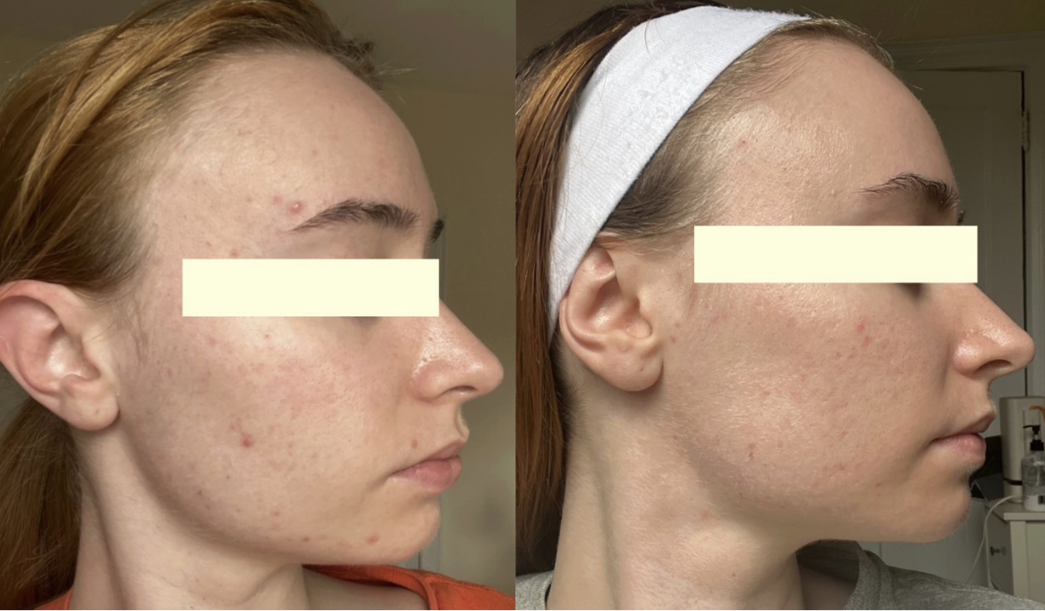 Root cause acne specialist and naturopathic doctor offering virtual 1:1 sessions and functional lab testing to uncover hormonal, gut, and lifestyle imbalances driving acne. Clear your skin from the inside out with personalized, holistic care.