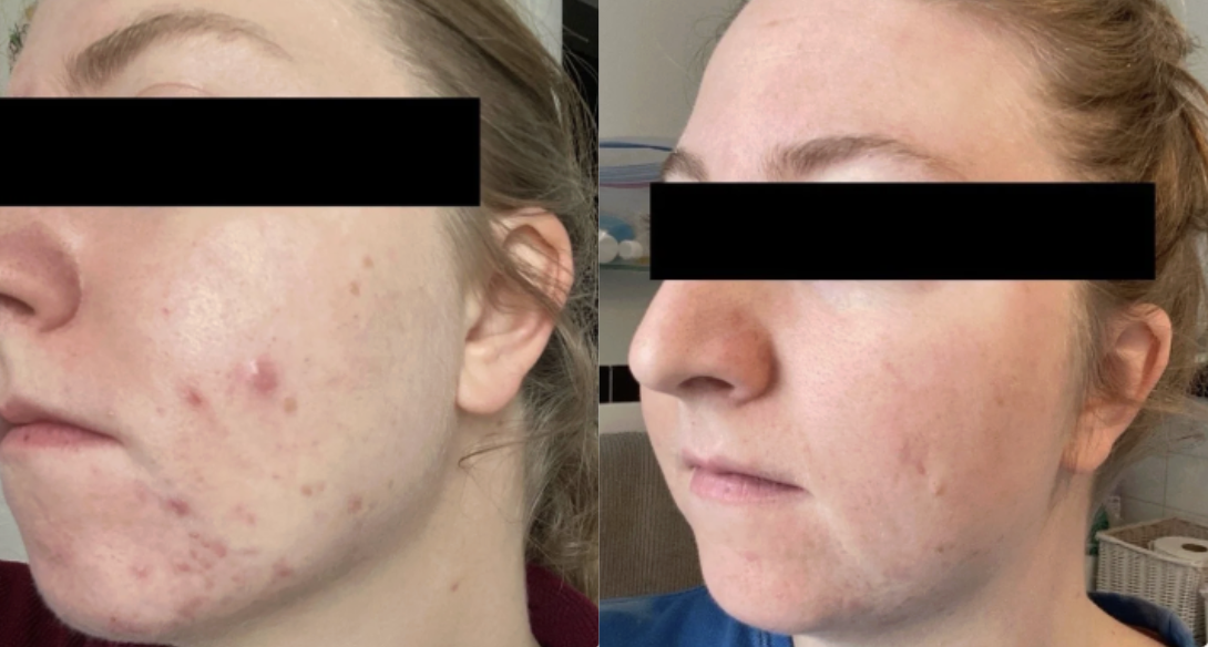 Root cause acne specialist and naturopathic doctor offering virtual 1:1 sessions and functional lab testing to uncover hormonal, gut, and lifestyle imbalances driving acne. Clear your skin from the inside out with personalized, holistic care.