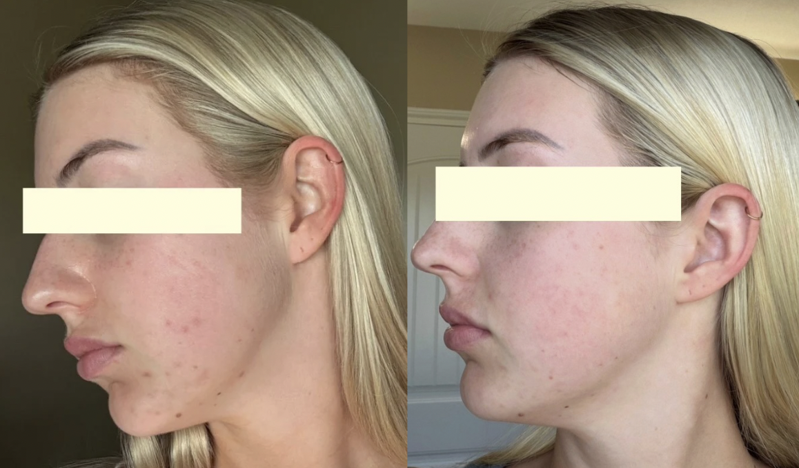 Root cause acne specialist and naturopathic doctor offering virtual 1:1 sessions and functional lab testing to uncover hormonal, gut, and lifestyle imbalances driving acne. Clear your skin from the inside out with personalized, holistic care.