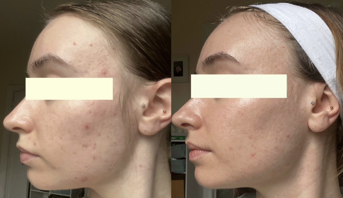 Root cause acne specialist and naturopathic doctor offering virtual 1:1 sessions and functional lab testing to uncover hormonal, gut, and lifestyle imbalances driving acne. Clear your skin from the inside out with personalized, holistic care.