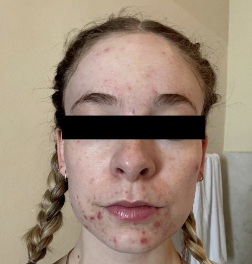 A young woman with acne and blemishes on her face, wearing her hair in braids and a black bar covering her eyes.