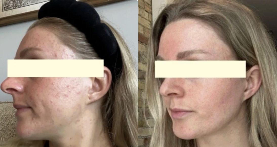 Root cause acne specialist and naturopathic doctor offering virtual 1:1 sessions and functional lab testing to uncover hormonal, gut, and lifestyle imbalances driving acne. Clear your skin from the inside out with personalized, holistic care.