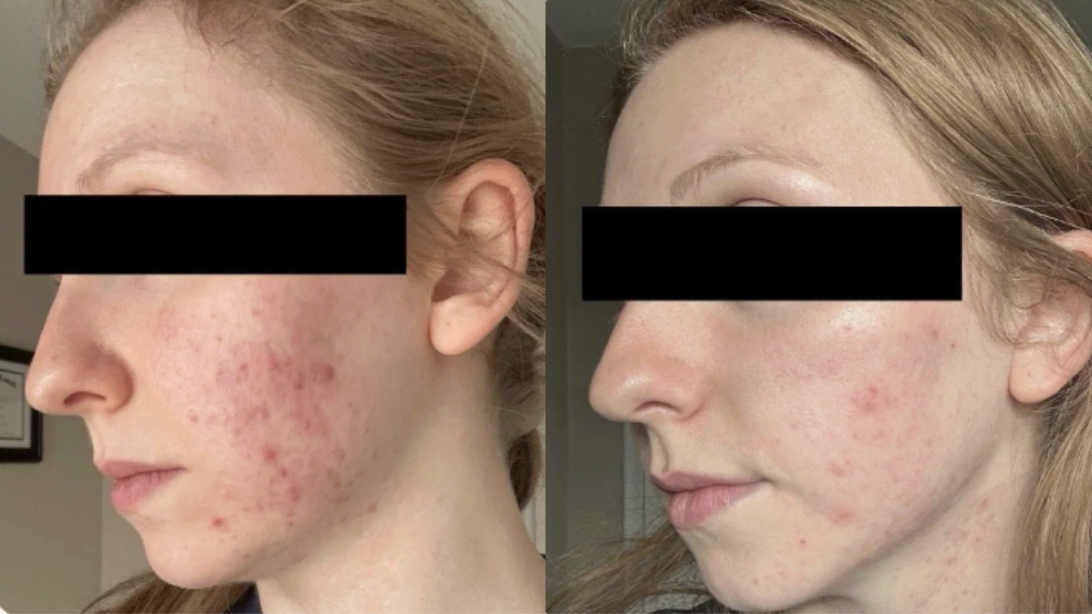 Root cause acne specialist and naturopathic doctor offering virtual 1:1 sessions and functional lab testing to uncover hormonal, gut, and lifestyle imbalances driving acne. Clear your skin from the inside out with personalized, holistic care.