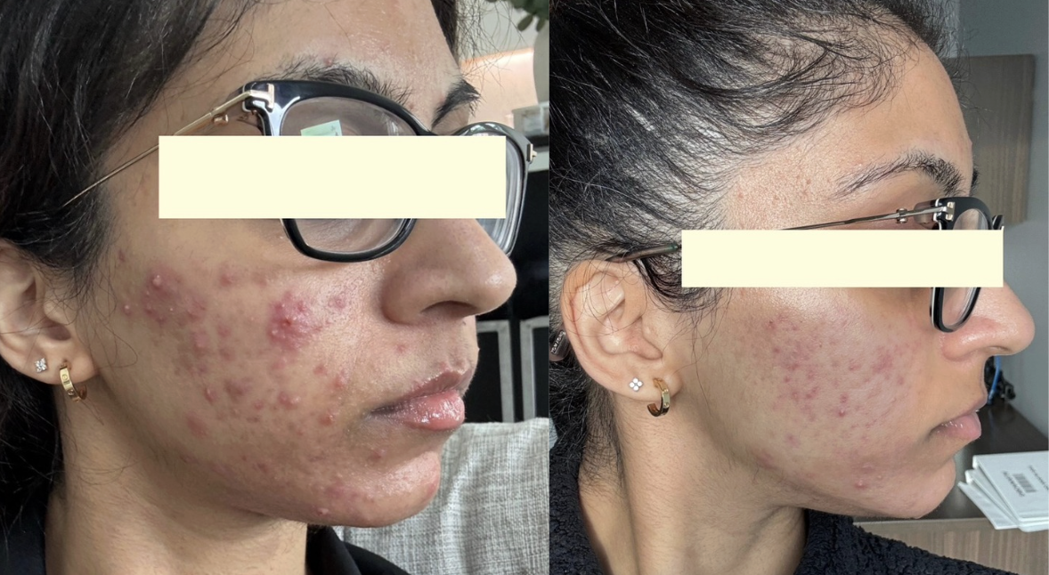Root cause acne specialist and naturopathic doctor offering virtual 1:1 sessions and functional lab testing to uncover hormonal, gut, and lifestyle imbalances driving acne. Clear your skin from the inside out with personalized, holistic care.