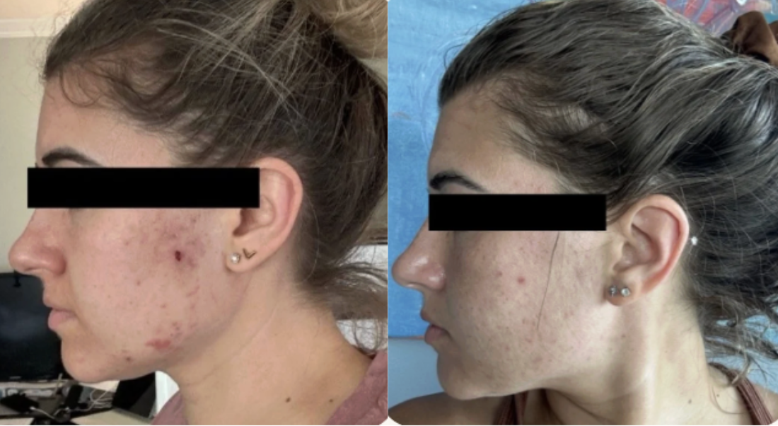 Root cause acne specialist and naturopathic doctor offering virtual 1:1 sessions and functional lab testing to uncover hormonal, gut, and lifestyle imbalances driving acne. Clear your skin from the inside out with personalized, holistic care.